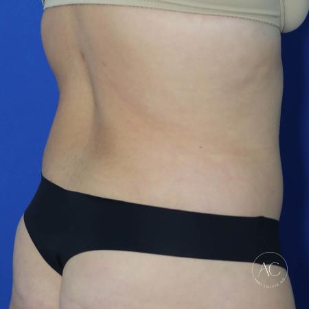 After image 4 Case #128071 - Circumferential trunk lipo/extended abdominoplasty