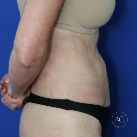 Before image 3 Case #128061 - Abdominoplasty