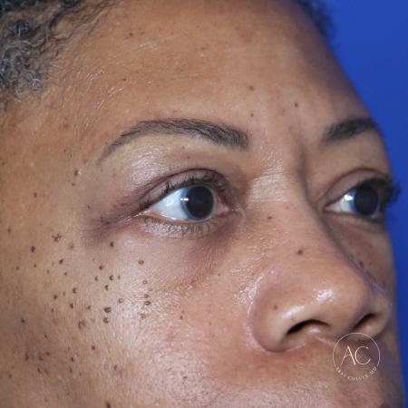 After image 2 Case #127921 - Upper blepharoplasty