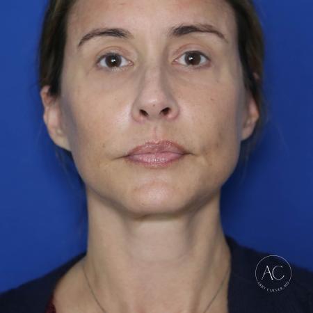 After image 1 Case #128201 - Deep plane facelift, necklift, upper/lower bleph