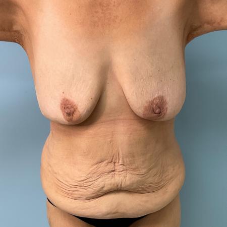 Before image 1 Case #127966 - 60 y.o. female' Tummy Tuck & Breast Aug w/ lift