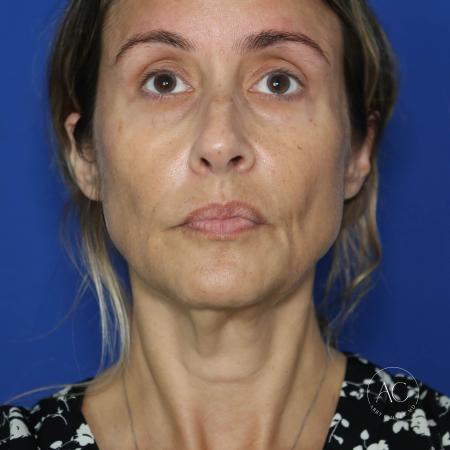 Before image 1 Case #128201 - Deep plane facelift, necklift, upper/lower bleph