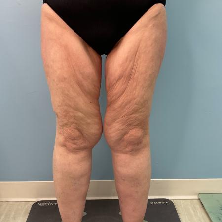 Before image 1 Case #128241 - 66 y.o. female w/ Thigh Lift & Lipo Thighs & Calf