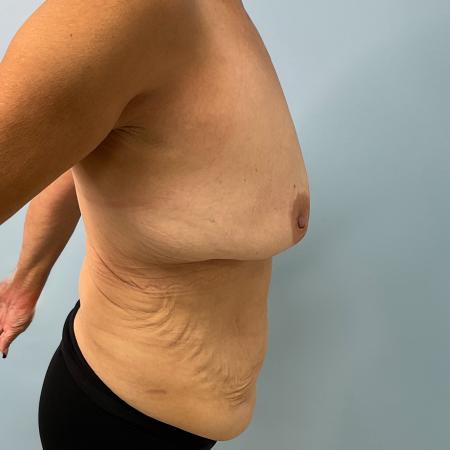 Before image 3 Case #127966 - 60 y.o. female' Tummy Tuck & Breast Aug w/ lift