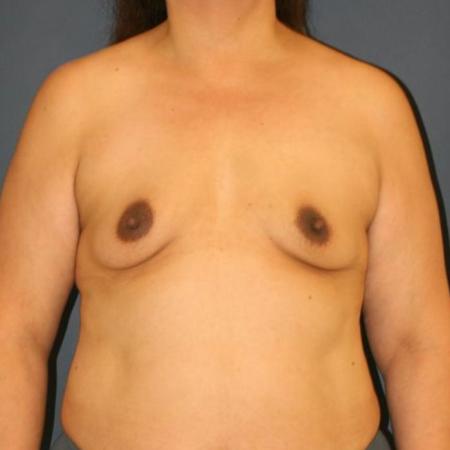 Before image 3 Case #127621 - Breast Augmentation