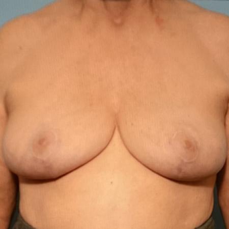 After image 1 Case #128276 - Breast Lifting after sixties!