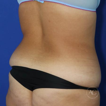 Before image 4 Case #128071 - Circumferential trunk lipo/extended abdominoplasty