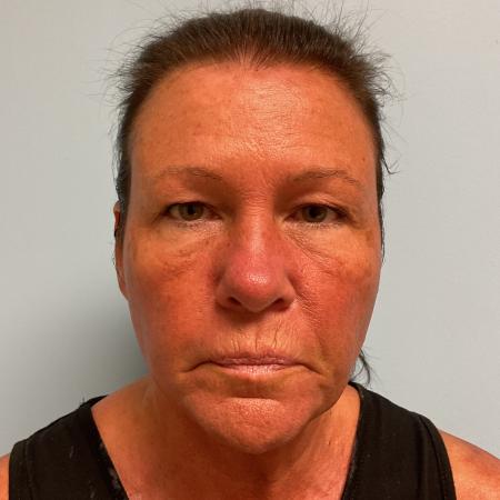 Before image 1 Case #128336 - 59 y.o. female w/ Neck & Face Lift 