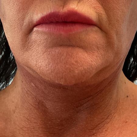 After image 3 Case #128336 - 59 y.o. female w/ Neck & Face Lift 