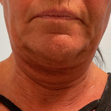 Before image 3 Case #128336 - 59 y.o. female w/ Neck & Face Lift 