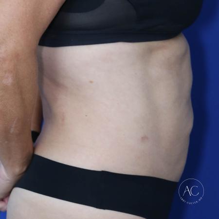 Before image 3 Case #128771 - Abdominoplasty