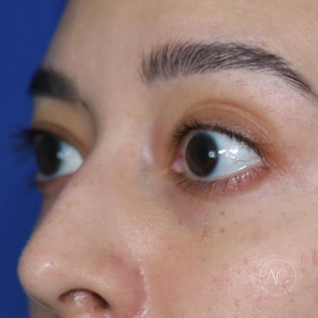 Before image 2 Case #128821 - Upper blepharoplasty