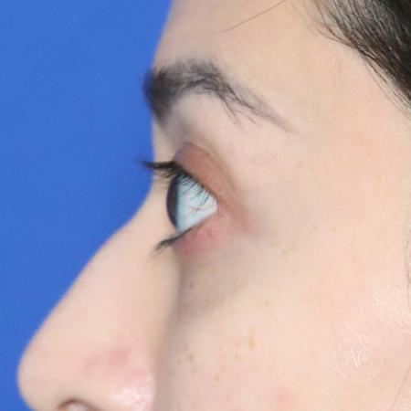 After image 3 Case #128821 - Upper blepharoplasty