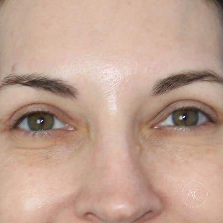 After image 1 Case #128766 - Upper blepharoplasty
