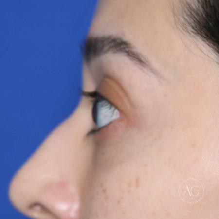 Before image 3 Case #128821 - Upper blepharoplasty