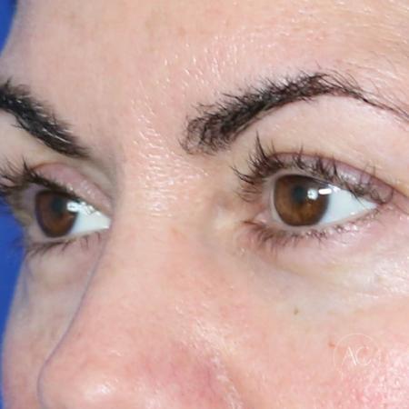 Before image 2 Case #128786 - Upper blepharoplasty