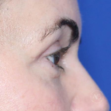 After image 3 Case #128786 - Upper blepharoplasty