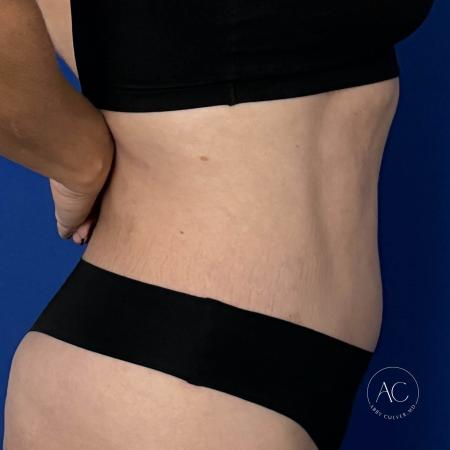 After image 3 Case #128771 - Abdominoplasty