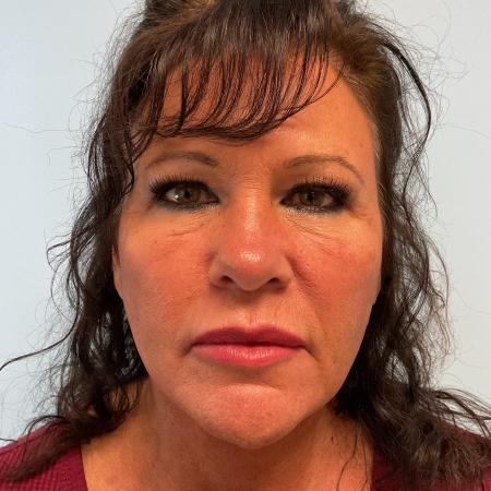 After image 1 Case #128336 - 59 y.o. female w/ Neck & Face Lift 