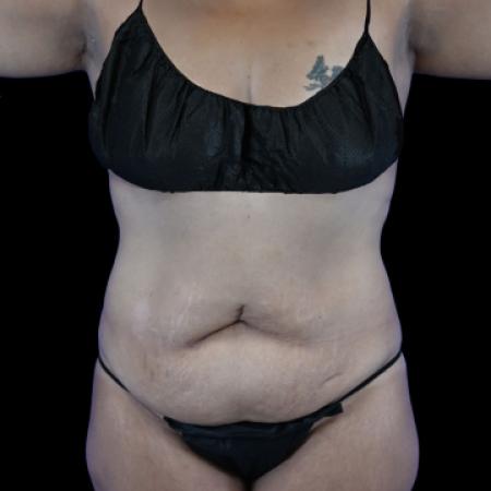 Before image 1 Case #129136 - Tummy Tuck