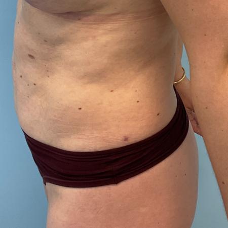 After image 3 Case #129341 - 40 y.o. female with liposuction of abs 