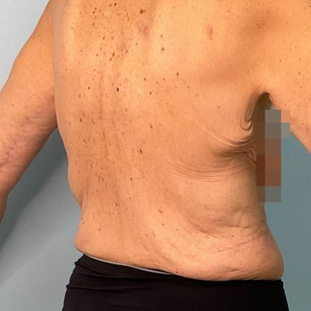 Before image 1 Case #129166 - 63 y.o. female with Bra Line Lift