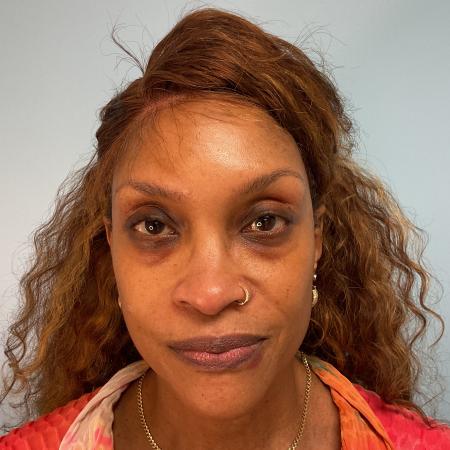 Before image 1 Case #129446 - 53 y.o. female with Belotero and Versa Fillers