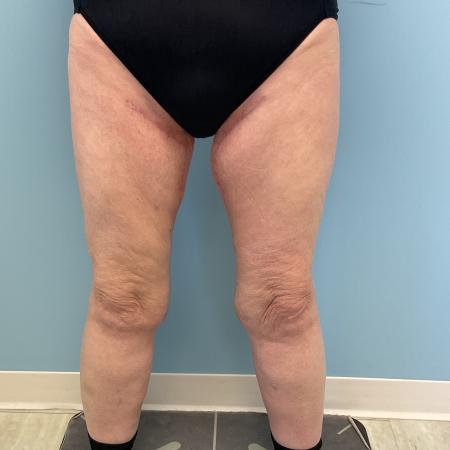 After image 1 Case #128241 - 66 y.o. female w/ Thigh Lift & Lipo Thighs & Calf