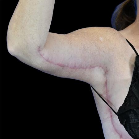 After image 2 Case #129131 - Revision arm lift (brachioplasty)