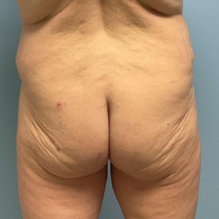 Before image 2 Case #129256 - 38 y.o. with BBL through Fat Transfer