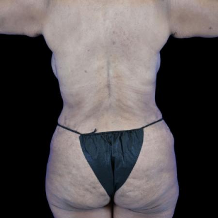 After image 3 Case #129141 - Tummy Tuck