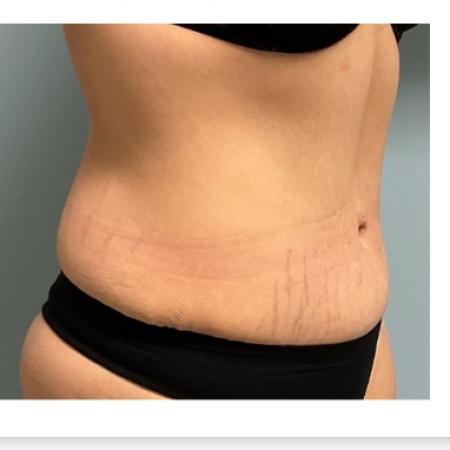 After Case #129056 - 33 y.o. female w/ Tummy Tuck, Lipo and BBL