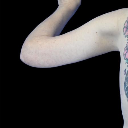 After image 2 Case #129146 - Arm lift with forearm reduction