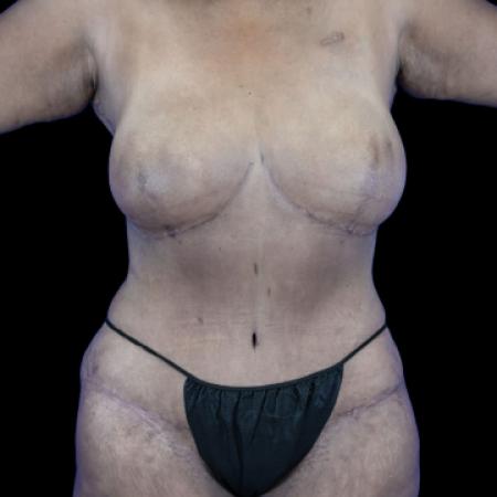 After image 1 Case #129141 - Tummy Tuck