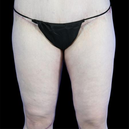After image 1 Case #129151 - Thighplasty