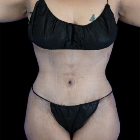 After image 1 Case #129136 - Tummy Tuck