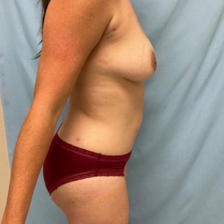 After image 2 Case #129106 - 39 y.o. female w/ Tummy Tuck, Lipo & Fat Transfer