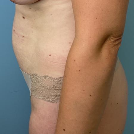 Before image 3 Case #129341 - 40 y.o. female with liposuction of abs 