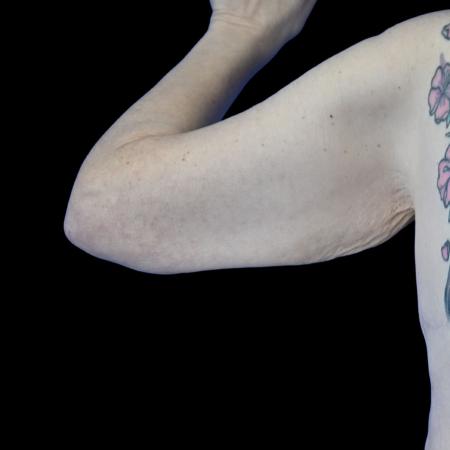 Before image 2 Case #129146 - Arm lift with forearm reduction