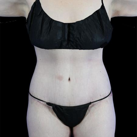After image 1 Case #129156 - High-Definition Lower Body Lift