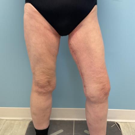 After image 2 Case #128241 - 66 y.o. female w/ Thigh Lift & Lipo Thighs & Calf