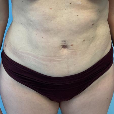 After image 1 Case #129341 - 40 y.o. female with liposuction of abs 