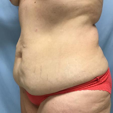 Before image 2 Case #129086 - 50 y.o. female with Tummy Tuck