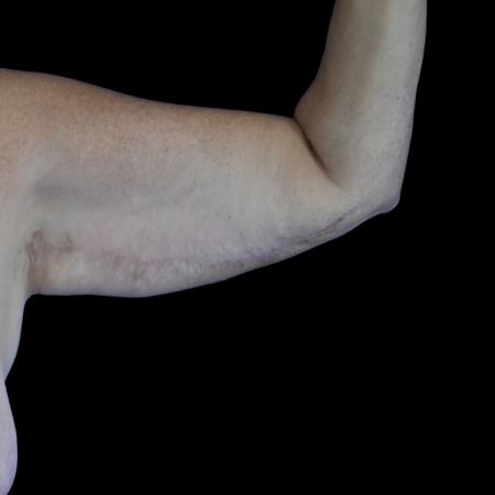 Before image 3 Case #129131 - Revision arm lift (brachioplasty)