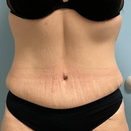 After Case #129056 - 33 y.o. female w/ Tummy Tuck, Lipo and BBL