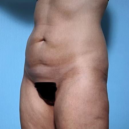 After image 2 Case #128296 - Liposuction 
