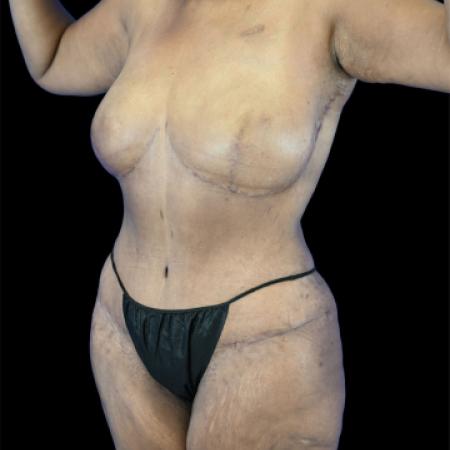 After image 2 Case #129141 - Tummy Tuck