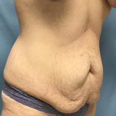 Before Case #129056 - 33 y.o. female w/ Tummy Tuck, Lipo and BBL