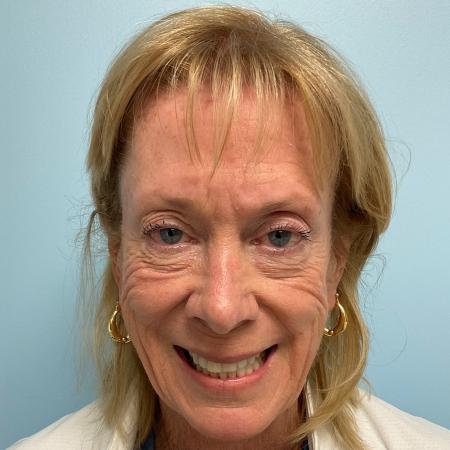 Before image 1 Case #129006 - 71 y.o. female with Botox and Filler