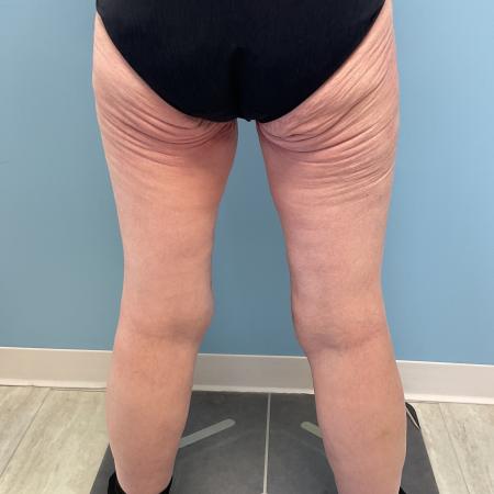 After image 4 Case #128241 - 66 y.o. female w/ Thigh Lift & Lipo Thighs & Calf